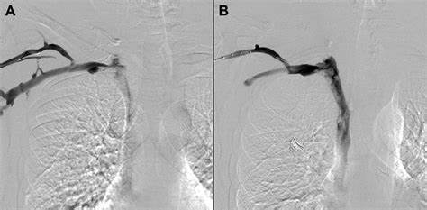 سندروم TOS وریدی در نمای ونوگرافی Venous Thoracic Outlet Syndrome in Venography