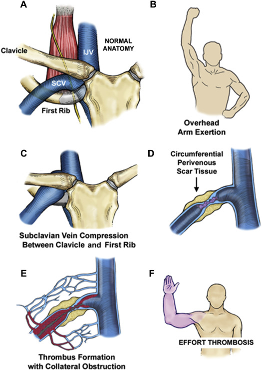 مراحل تشکیل ترومبوز ورید عمقی اندام فوقانی در سندروم TOS وریدی Stages of Upper Extrimity Deep Vein Thrombosis in Venous TOS