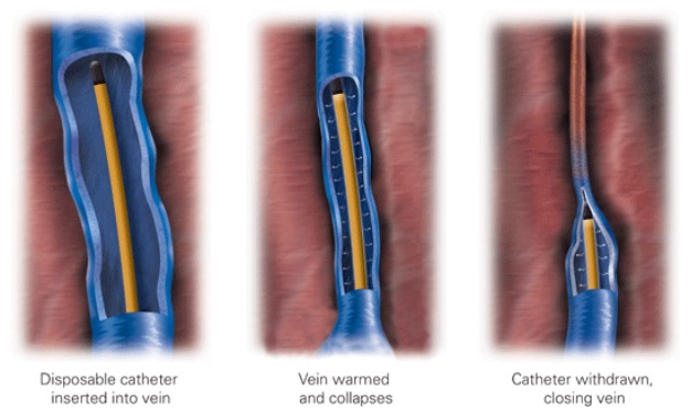 مراحل انجام درمان واریس با لیزر (RF) Stages of Treatment of Varicose Veins with Radiofrequency Ablation