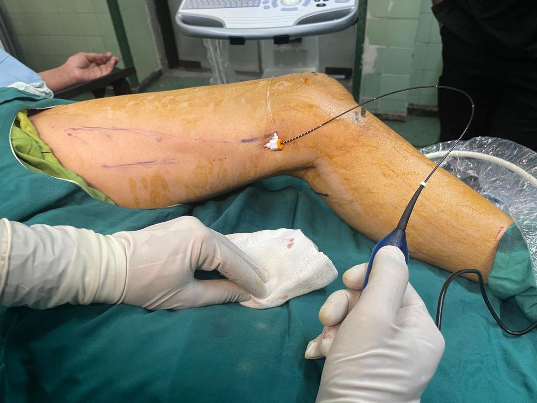 درمان واریس با لیزر واریس به روش RFA Treatment of Varicose Veins with Radiofrequency Ablation