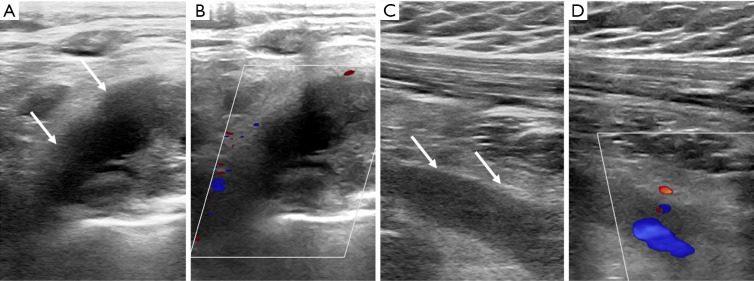 سندروم TOS وریدی در نمای سونوگرافی Venous Thoracic Outlet Syndrome in Sonography