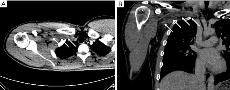 سندروم TOS وریدی در نمای سی تی اسکن در فاز وریدی Venous Thoracic Outlet Syndrome in CT Scan in Venous Phase