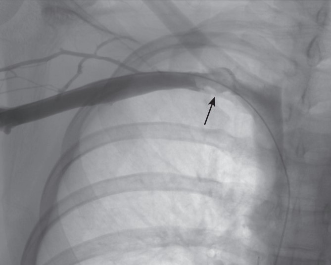 درمان سندروم TOS وریدی Treatment of Venous Thoracic Outlet Syndrome