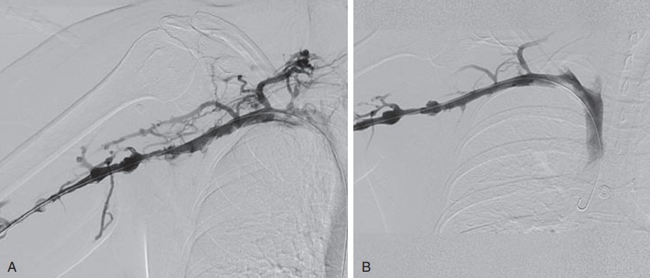 نقش درمان ترومبولیتیک در سندروم TOS وریدی The role of thrombolytic therapy in treatment of Venous Thoracic Outlet Syndrome