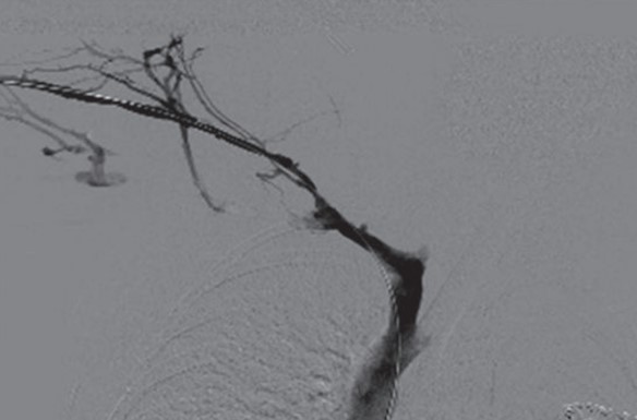 جراحی برداشتن فشار در سندروم TOS وریدی Surgical Decompression of Venous Thoracic Outlet Syndrome