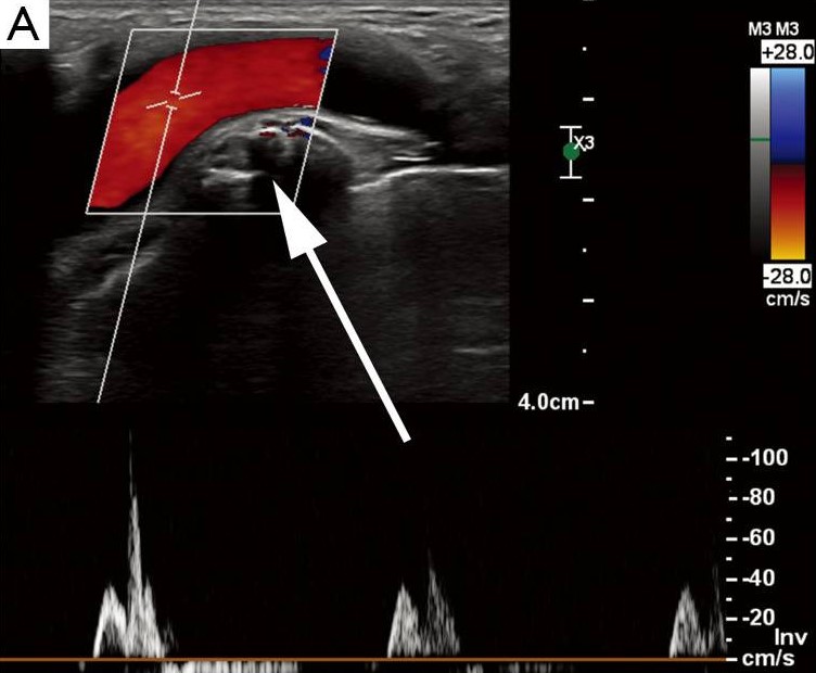 سندروم خروجی قفسه سینه شریانی در نمای سونوگرافی Arterial Thoracic Outlet Syndrome in Sonography