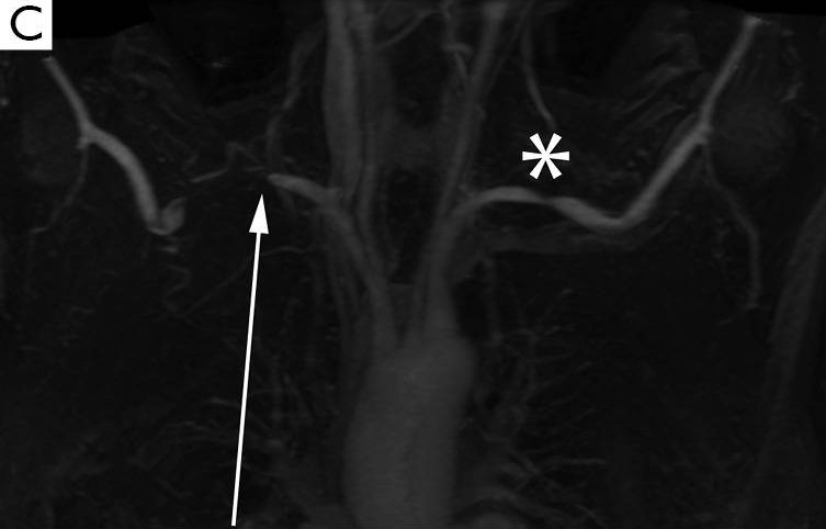 سندروم خروجی قفسه سینه شریانی در نمای آنژیوگرافی با MRI Arterial Thoracic Outlet Syndrome in MRA