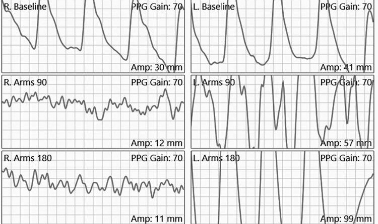 سندروم TOS شریانی در تست حجم ضربان Arterial Thoracic Outlet Syndrome in Pulse Volume Test