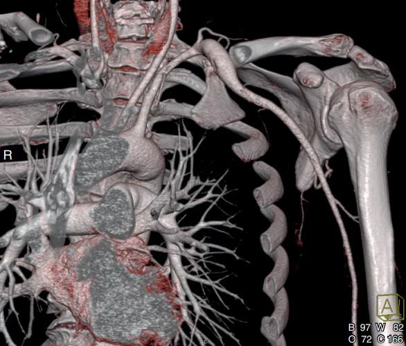 سندروم TOS شریانی و گشادشدن شریان ساب کلاوین پس از محل تنگی Post-Stenotic Dilatation in Subclavian Artery in Arterial Thoracic Outlet Syndrome