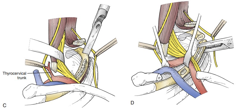 جراحی برداشتن فشار خروجی قفسه سینه در سندروم TOS شریانی Surgical Decompression in Arterial Thoracic Outlet Syndrome