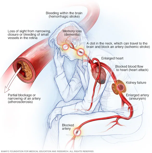 The Effects of Hypertension on Blood Vessels