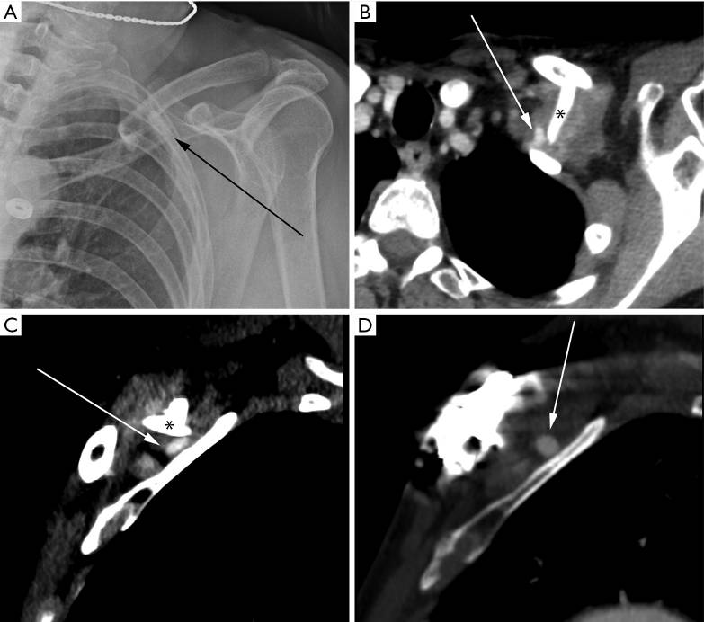 سندروم TOS شریانی در نمای سی تی آنژیوگرافی Arterial Thoracic Outlet Syndrome in CT Angiography