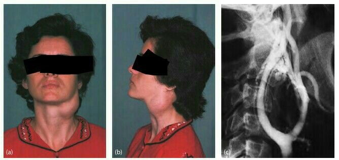 تظاهرات بالینی تومور جسم کاروتید Clinical manifestations of carotid body tumor