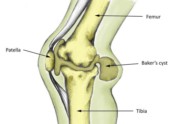 علائم بالینی کیست بیکر Clinical manifestations of Baker's cyst