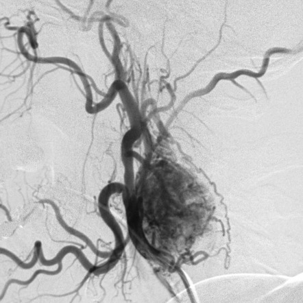 تومور جسم کاروتید در نمای آنژیوگرافی Carotid body tumor on Conventional Angiography