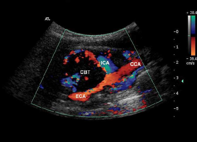 تومور جسم کاروتید در نمای سونوگرافی Carotid body tumor on Ultrasound