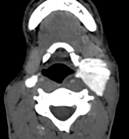 تومور جسم کاروتید در نمای سی تی آنژیوگرافی Carotid body tumor on CT Angiography