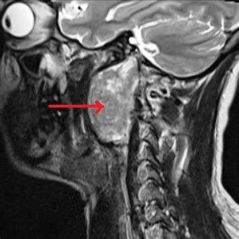 تومور جسم کاروتید در نمای MRA Carotid body tumor on MR Angiography