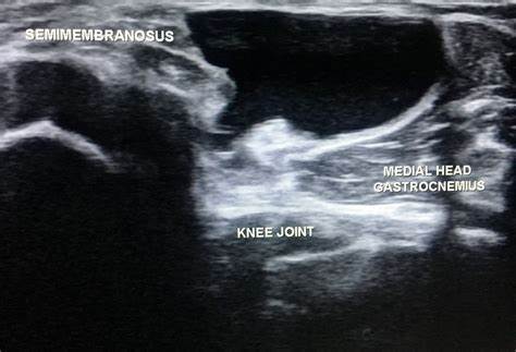 کیست بیکر در نمای سونوگرافی Baker's cyst on Sonography