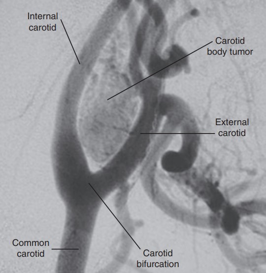 تشخیص تومور جسم کاروتید Diagnosis of Carotid body tumor