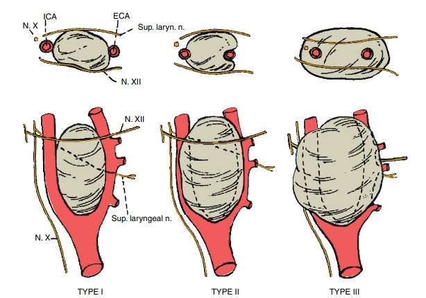 طبقه بندی تومور جسم کاروتید Shamblin classification of Carotid body tumor