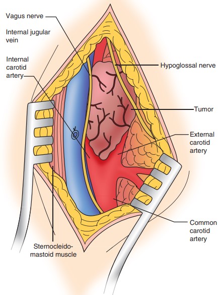 مجاورت های آناتومیک تومور جسم کاروتید Anatomic proximities of carotid body tumor