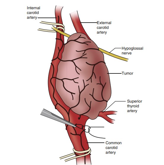 برداشتن تومور جسم کاروتید با جراحی Surgical resection of carotid body tumor