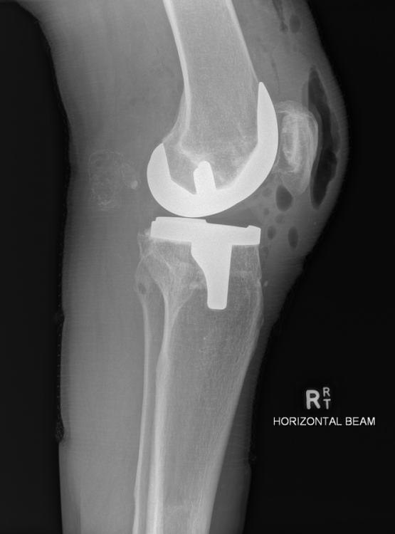 کیست بیکر در نمای رادیوگرافی زانو Baker's cyst on knee radiography