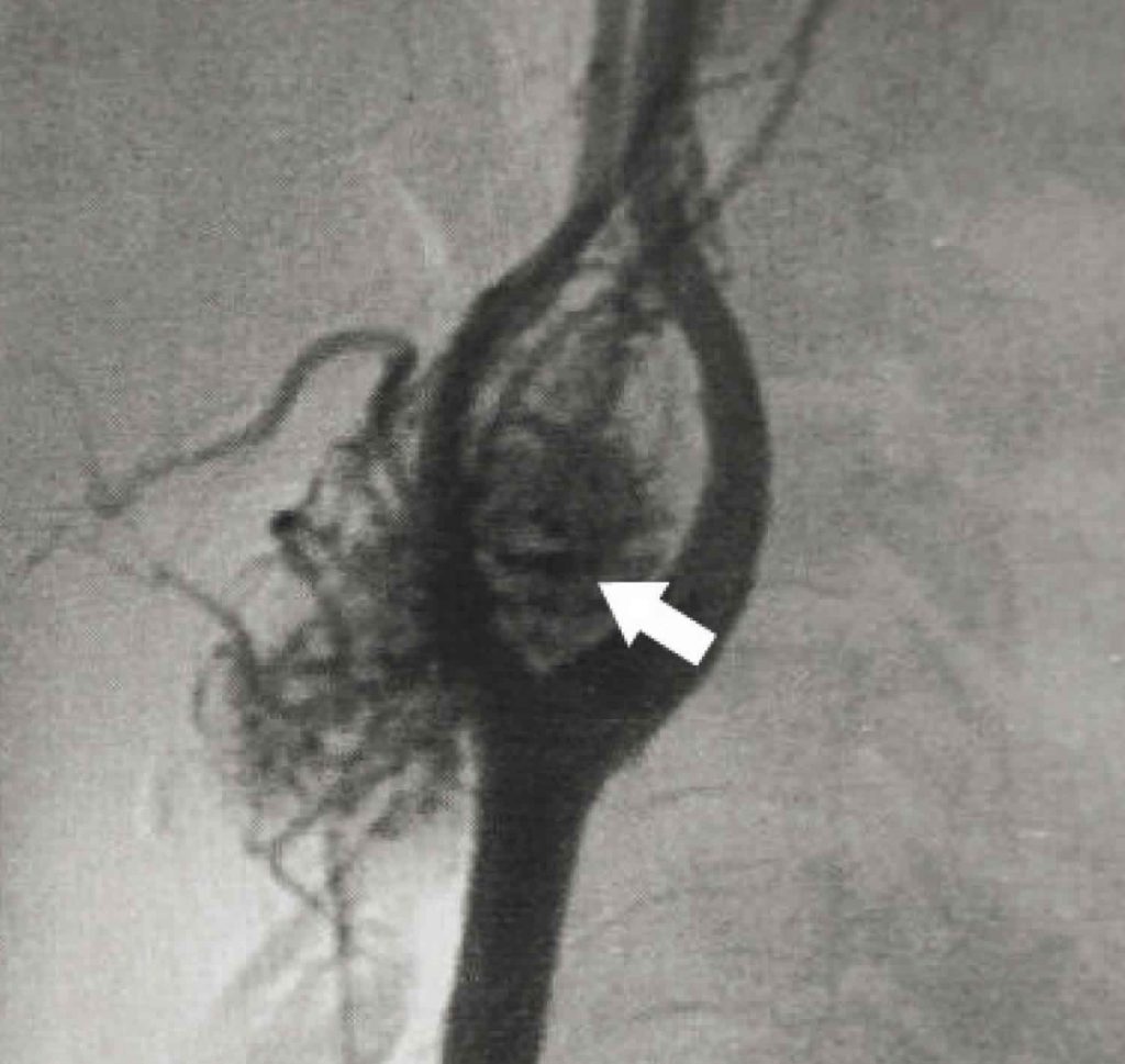 درمان تومور جسم کاروتید Treatment of Carotid body tumor