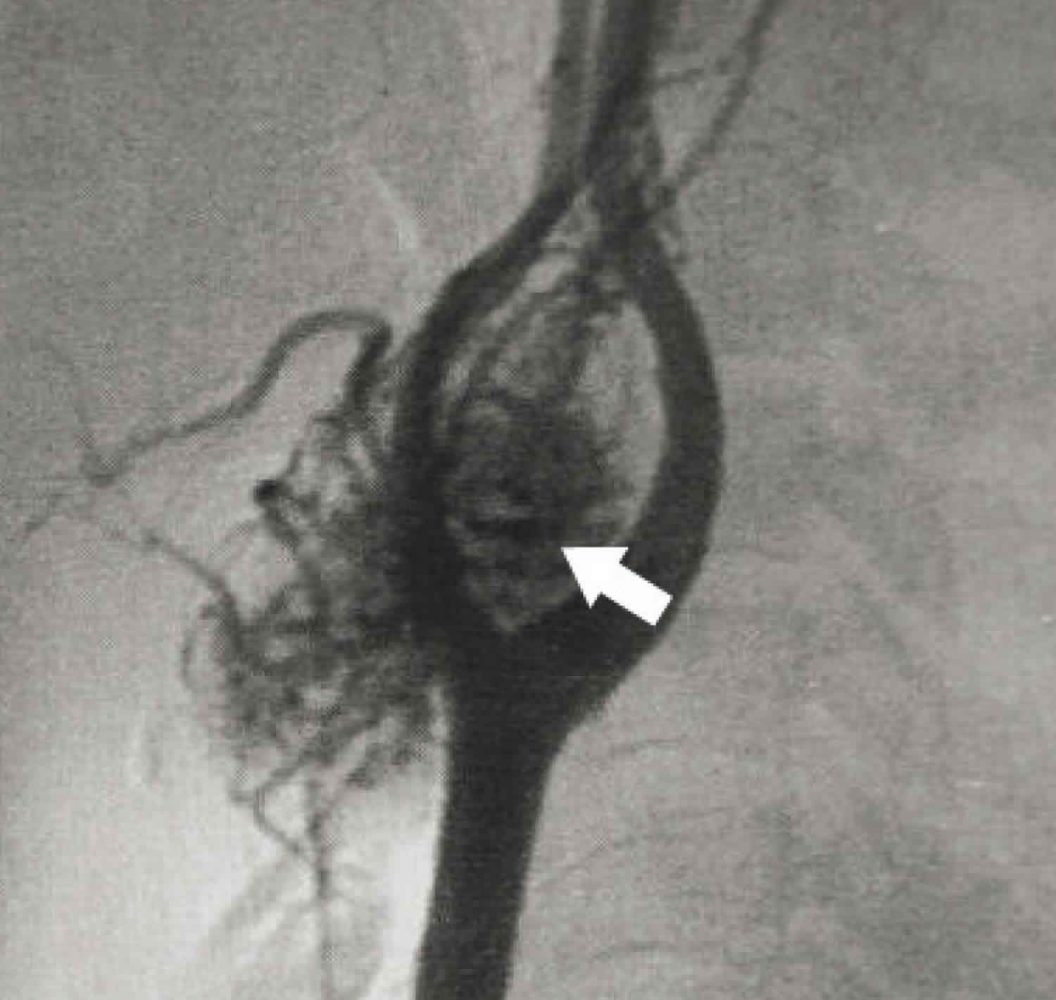 درمان تومور جسم کاروتید Treatment of Carotid body tumor