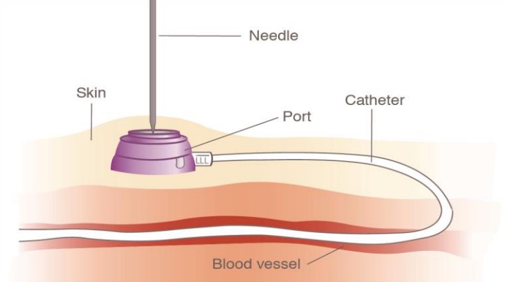 کاتتر های پورت کاشتنی Implantable Port Catheters جراح عروق (Vascular Surgeon) بهترین جراح عروق (Best Vascular Surgeon) متخصص جراحی عروق (Vascular Surgery Specialist) جراحی عروق و اندوواسکولار (Vascular and Endovascular Surgery) درمان بیماری‌های عروق (Vascular Disease Treatment) تکنیک‌های جراحی عروق (Vascular Surgery Techniques) جراح اندوواسکولار (Endovascular Surgeon) درمان غیرتهاجمی عروق (Non-Invasive Vascular Treatment) پزشک جراحی عروق (Vascular Surgery Doctor) مراقبت‌های جراحی عروق (Vascular Surgery Care)