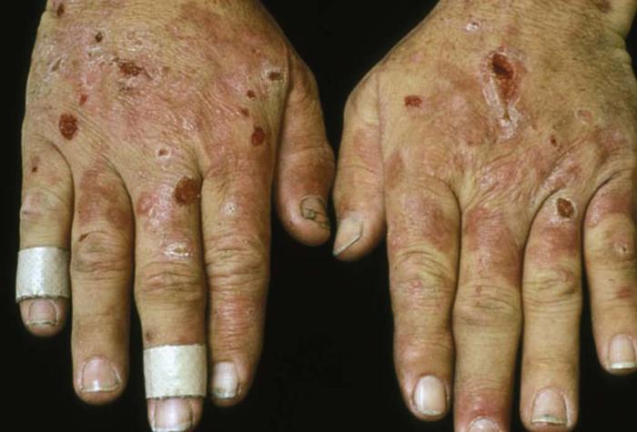 تظاهرات پوستی بیماری های عروقی cutaneous manifestations of vascular diseases جراح عروق (Vascular Surgeon) بهترین جراح عروق (Best Vascular Surgeon) متخصص جراحی عروق (Vascular Surgery Specialist) جراحی عروق و اندوواسکولار (Vascular and Endovascular Surgery) درمان بیماریهای عروق (Vascular Disease Treatment) تکنیکهای جراحی عروق (Vascular Surgery Techniques) جراح اندوواسکولار (Endovascular Surgeon) درمان غیرتهاجمی عروق (Non-Invasive Vascular Treatment) پزشک جراحی عروق (Vascular Surgery Doctor) مراقبتهای جراحی عروق (Vascular Surgery Care)
