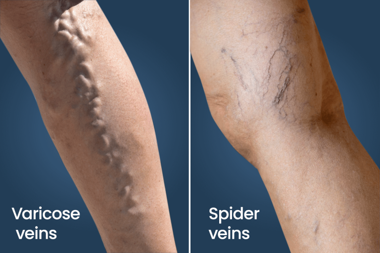 وریدهای واریسی در مقایسه با وریدهای عنکبوتی Spider veins Vs. Varicose veins جراح عروق (Vascular Surgeon) بهترین جراح عروق (Best Vascular Surgeon) متخصص جراحی عروق (Vascular Surgery Specialist) جراحی عروق و اندوواسکولار (Vascular and Endovascular Surgery) درمان بیماریهای عروق (Vascular Disease Treatment) تکنیکهای جراحی عروق (Vascular Surgery Techniques) جراح اندوواسکولار (Endovascular Surgeon) درمان غیرتهاجمی عروق (Non-Invasive Vascular Treatment) پزشک جراحی عروق (Vascular Surgery Doctor) مراقبتهای جراحی عروق (Vascular Surgery Care)
