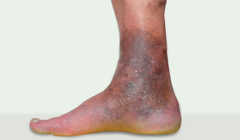 لیپودرماتوسکلروزیس در واریس Lipodermatosclerosis in Varicose Veins جراحی عروق (Vascular Surgery) جراح عروق (Vascular Surgeon) بهترین جراح عروق (Best Vascular Surgeon) متخصص جراحی عروق (Vascular Surgery Specialist) جراحی عروق و اندوواسکولار (Vascular and Endovascular Surgery) درمان بیماریهای عروق (Vascular Disease Treatment) تکنیکهای جراحی عروق (Vascular Surgery Techniques) جراح اندوواسکولار (Endovascular Surgeon) درمان غیرتهاجمی عروق (Non-Invasive Vascular Treatment) پزشک جراحی عروق (Vascular Surgery Doctor) مراقبتهای جراحی عروق (Vascular Surgery Care) شیراز(Shiraz) جراحی عروق شیراز(Shiraz Vascular Surgery) جراح عروق شیراز(Shiraz Vascular Surgeon) بهترین جراح عروق شیراز(Best Shiraz Vascular Surgeon)