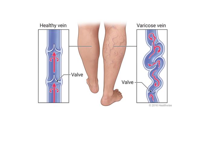 تغییرات ساختار وریدی در واریس Changes in Venous Structure in Varicose Veins جراح عروق (Vascular Surgeon) بهترین جراح عروق (Best Vascular Surgeon) متخصص جراحی عروق (Vascular Surgery Specialist) جراحی عروق و اندوواسکولار (Vascular and Endovascular Surgery) درمان بیماریهای عروق (Vascular Disease Treatment) تکنیکهای جراحی عروق (Vascular Surgery Techniques) جراح اندوواسکولار (Endovascular Surgeon) درمان غیرتهاجمی عروق (Non-Invasive Vascular Treatment) پزشک جراحی عروق (Vascular Surgery Doctor) مراقبتهای جراحی عروق (Vascular Surgery Care)
