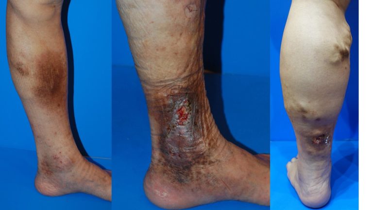 زخم های وریدی و تغییر رنگ پوست Skin Discoloration and Venous Ulcers جراحی عروق (Vascular Surgery) جراح عروق (Vascular Surgeon) بهترین جراح عروق (Best Vascular Surgeon) متخصص جراحی عروق (Vascular Surgery Specialist) جراحی عروق و اندوواسکولار (Vascular and Endovascular Surgery) درمان بیماریهای عروق (Vascular Disease Treatment) تکنیکهای جراحی عروق (Vascular Surgery Techniques) جراح اندوواسکولار (Endovascular Surgeon) درمان غیرتهاجمی عروق (Non-Invasive Vascular Treatment) پزشک جراحی عروق (Vascular Surgery Doctor) مراقبتهای جراحی عروق (Vascular Surgery Care) شیراز(Shiraz) جراحی عروق شیراز(Shiraz Vascular Surgery) جراح عروق شیراز(Shiraz Vascular Surgeon) بهترین جراح عروق شیراز(Best Shiraz Vascular Surgeon)