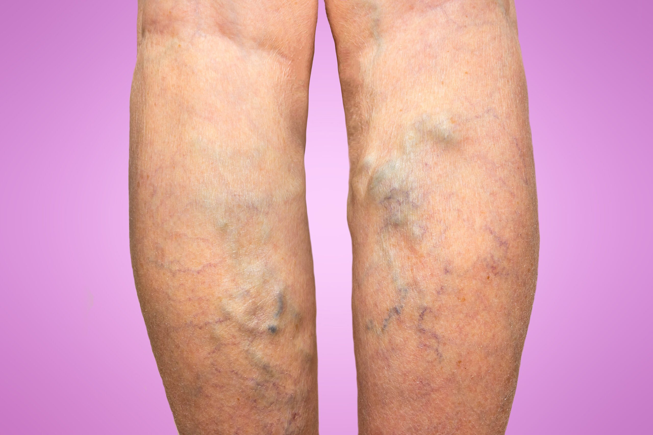 نشانه های پوستی واریس Skin Signs of Varicose Veins جراح عروق (Vascular Surgeon) بهترین جراح عروق (Best Vascular Surgeon) متخصص جراحی عروق (Vascular Surgery Specialist) جراحی عروق و اندوواسکولار (Vascular and Endovascular Surgery) درمان بیماریهای عروق (Vascular Disease Treatment) تکنیکهای جراحی عروق (Vascular Surgery Techniques) جراح اندوواسکولار (Endovascular Surgeon) درمان غیرتهاجمی عروق (Non-Invasive Vascular Treatment) پزشک جراحی عروق (Vascular Surgery Doctor) مراقبتهای جراحی عروق (Vascular Surgery Care)