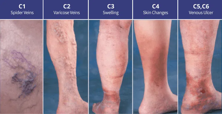 مراحل تظاهرات پوستی نارسایی مزمن وریدی Stages of Skin Manifestations of Chronic Venous Insufficiency جراحی عروق (Vascular Surgery) جراح عروق (Vascular Surgeon) بهترین جراح عروق (Best Vascular Surgeon) متخصص جراحی عروق (Vascular Surgery Specialist) جراحی عروق و اندوواسکولار (Vascular and Endovascular Surgery) درمان بیماریهای عروق (Vascular Disease Treatment) تکنیکهای جراحی عروق (Vascular Surgery Techniques) جراح اندوواسکولار (Endovascular Surgeon) درمان غیرتهاجمی عروق (Non-Invasive Vascular Treatment) پزشک جراحی عروق (Vascular Surgery Doctor) مراقبتهای جراحی عروق (Vascular Surgery Care) شیراز(Shiraz) جراحی عروق شیراز(Shiraz Vascular Surgery) جراح عروق شیراز(Shiraz Vascular Surgeon) بهترین جراح عروق شیراز(Best Shiraz Vascular Surgeon)